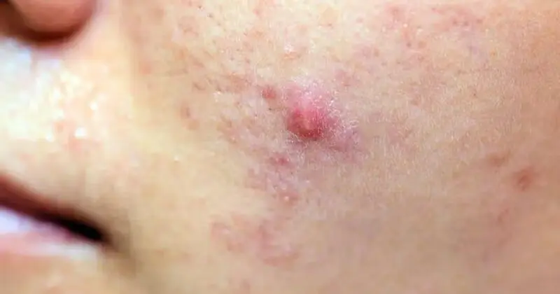 Sebab Jerawat: Panduan Lengkap Memahami Punca dan Penyelesaian Masalah Kulit 1 acne