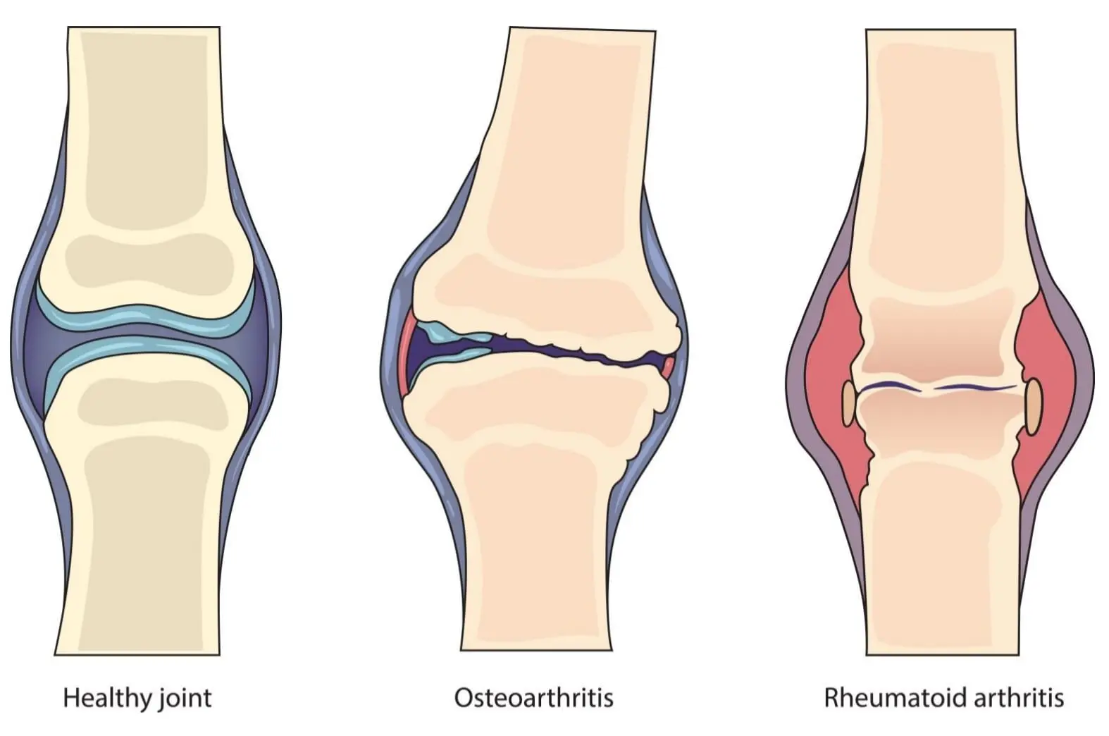 artritis
