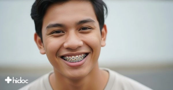 Braces Gigi: Panduan Komprehensif untuk Senyum Bahagaia