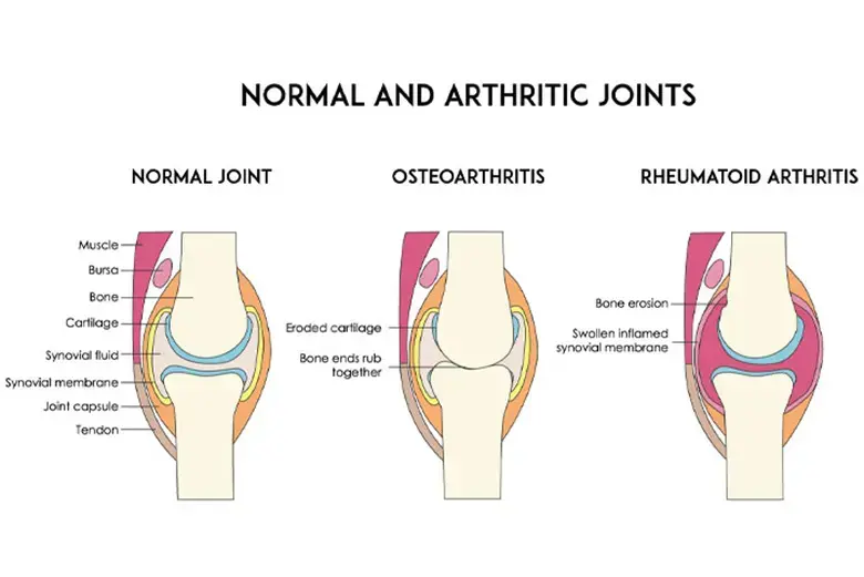 Suplemen Terbaik untuk Sakit Lutut: Panduan Lengkap untuk Kesihatan Sendi 1 degenerative joint