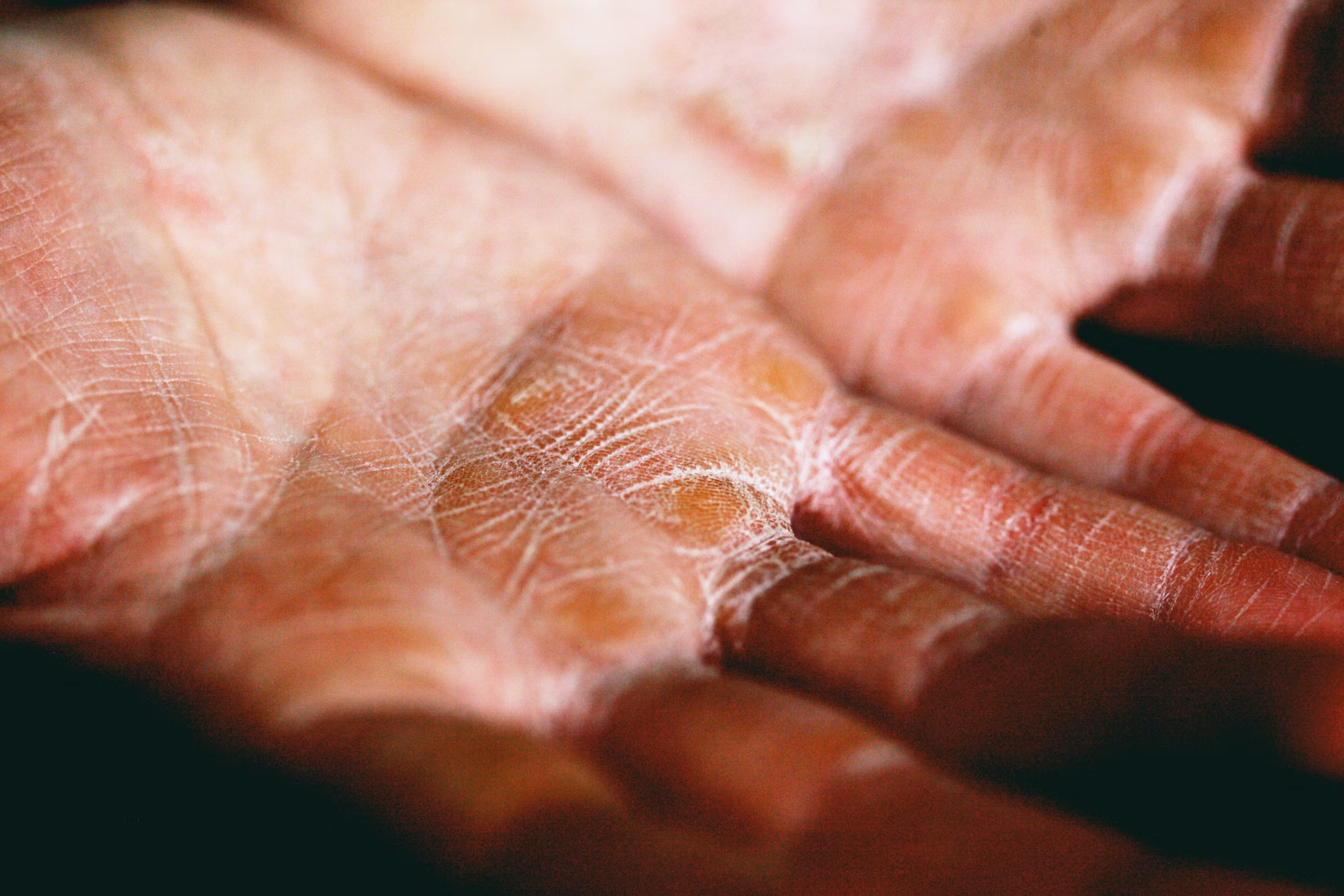 Panduan Lengkap Mengenai Ubat Eczema: Rawatan, Pencegahan dan Penjagaan 1 eczema