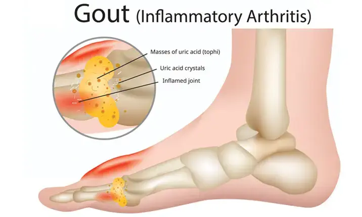 Ubat Gout: Panduan Lengkap untuk Menguruskan Kesakitan dan Mencegah Serangan 1 gout info