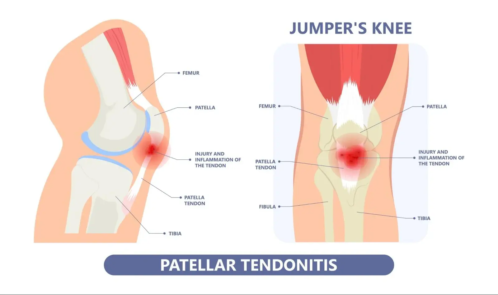 Sebab Sakit Lutut: Panduan Lengkap Untuk Memahami dan Menangani Masalah Lutut 4 jumpers knee