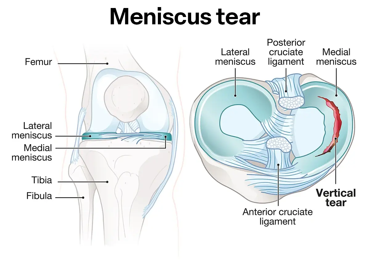 Sebab Sakit Lutut: Panduan Lengkap Untuk Memahami dan Menangani Masalah Lutut 2 meniscus tear