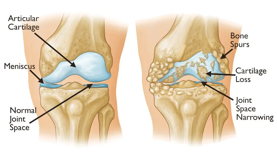 Sebab Sakit Lutut: Panduan Lengkap Untuk Memahami dan Menangani Masalah Lutut 3 osteoartitis